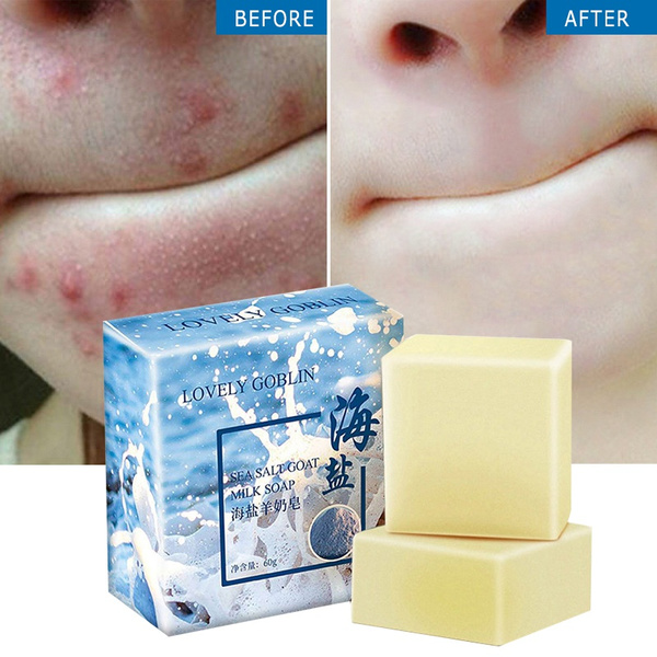 acne treatment sulfur wash