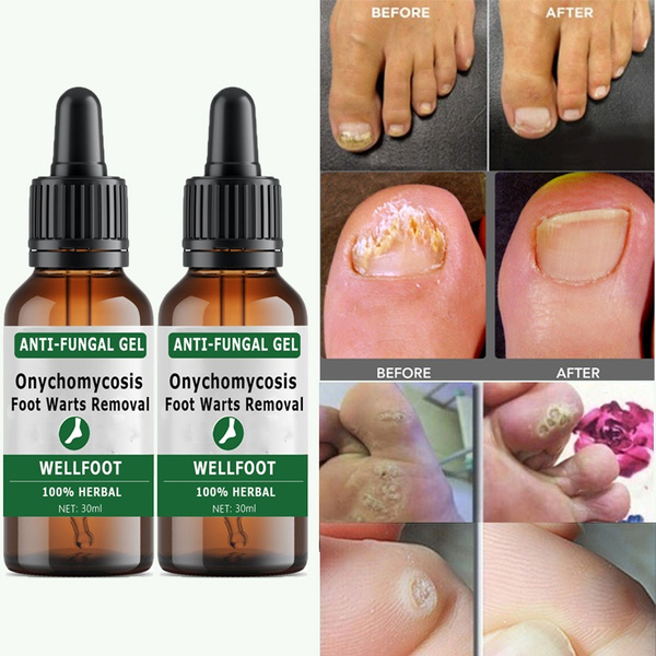 Share more than 143 nail polish remover for warts best noithatsi.vn