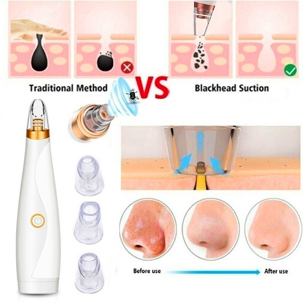 Blackhead Remover Skin Care Pore Vacuum Acne Pimple Removal Vacuum ...