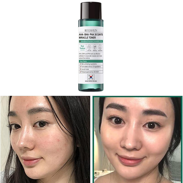 miracle acne treatment