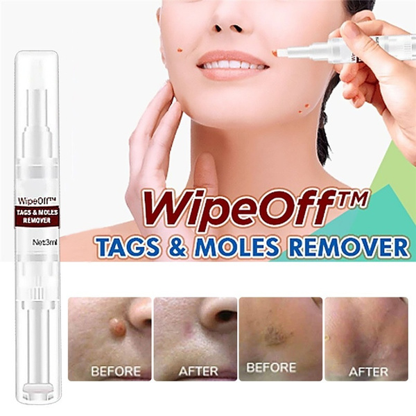 remove papillomas and warts