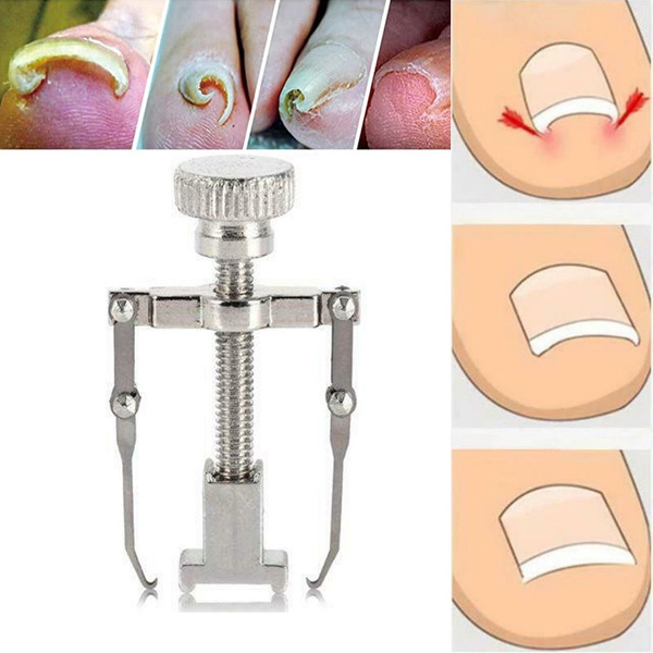 Gold Ingrown Toenail Corrector Tool – Pedicure Fixer For Toe Nail Pain Relief, USA Shipping