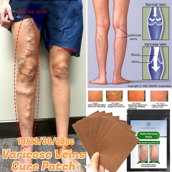 varicose corporation