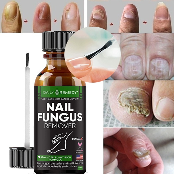 All Natural Nail Fungus Treatment, Best Nail Repair Product, Stop Fungal  Growth, Effective Fingernail & Toenail Solution, Fix & Renew Damaged,  Broken, Cracked & Discolored Nails | Wish