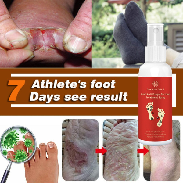 10ml/20ml/30ml/50ml Anti Fungal Infections Foot Spray for Athlete's