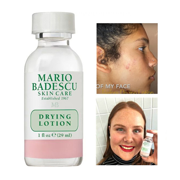 An effective Acne Treatment ORIGINAL Mario Badescu Drying 29ml Anti Acne Serum Pimple Blemish Removal | Wish