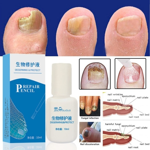 Fungal Nail Repair - Best Toenail Fungus Medication, 100% Plant Extracts -  Safe & Effective Treatment, 10 mL