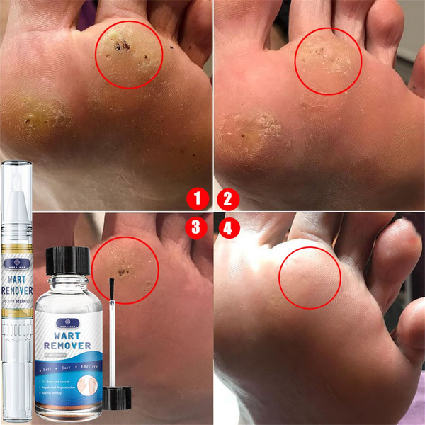 can you get rid of hpv plantar warts