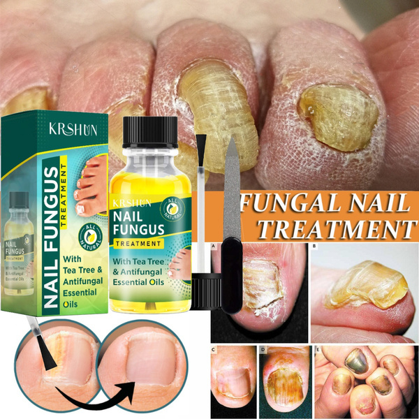 10ml/20ml/30ml/50ml 2021 New Nail Fungus Treatment Oil Effective Fungal ...