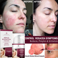 rosacea anti aging termékek