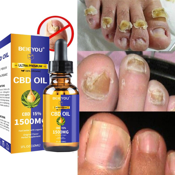 Fungi Nail Anti-Fungal Ointment, Kills Fungus That Can Lead to Nail &  Athletes Foot with
