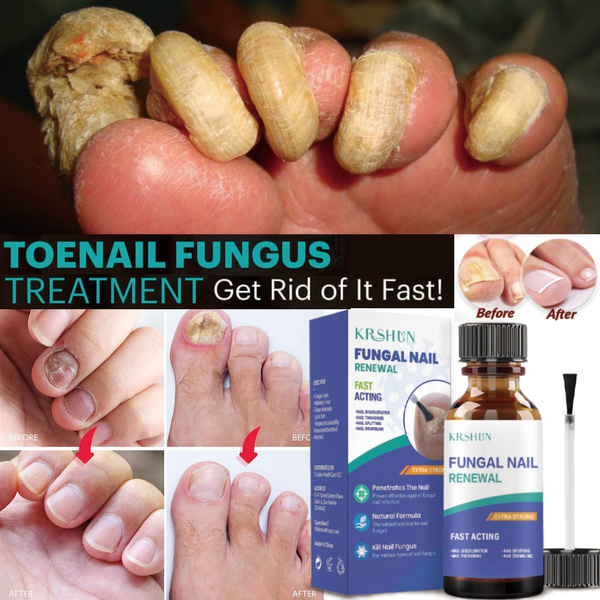 Antifungal Cream Fungus Killer Hand and Feet Nail Treatment - Walmart.com