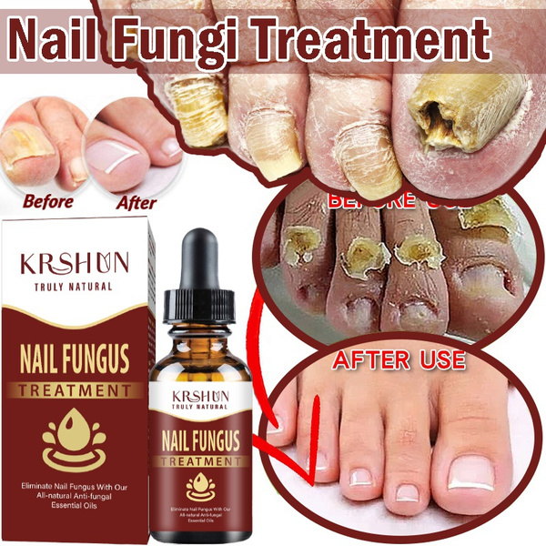 Oregano Oil for Nail Fungus, Oregano Oil Natural Antibacterial – Natural  Stuff