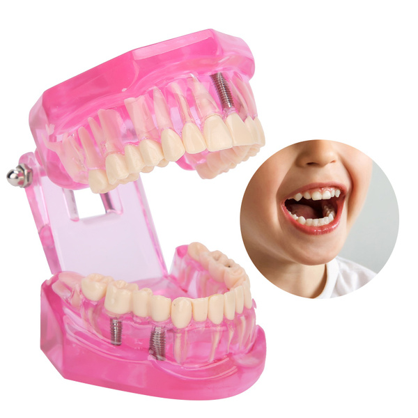 Transparent Teeth Model Dental Implant Teeth Model Dentist Dental