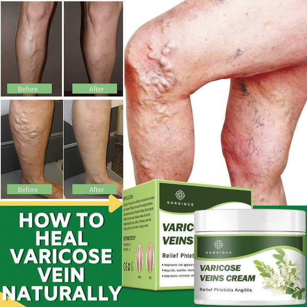 10g/30g/50g Varicose Veins Treatment Cream Chinese Herbal Medicines ...